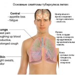 Фото: http://www.zdravosil.ru/pulmonologiya/tuberkulez/33558-tuberkulez-simptomy-diagnostika-vidy-lechenie.html